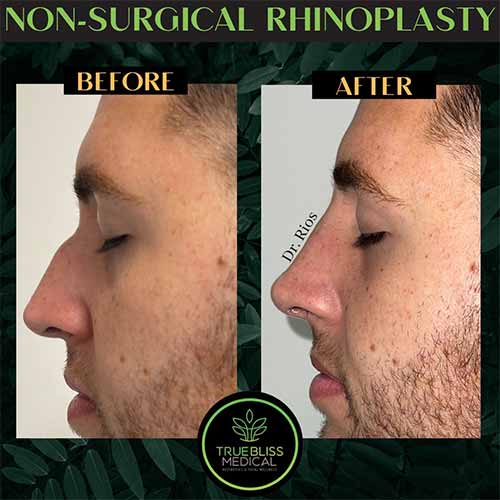 Non-Surgical Rhinoplasty Treatment in Verona, NJ