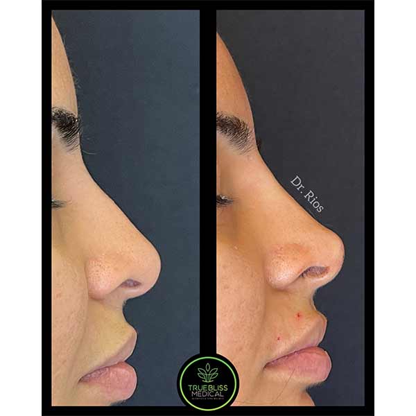 Non-Surgical Rhinoplasty Treatment in Verona, NJ