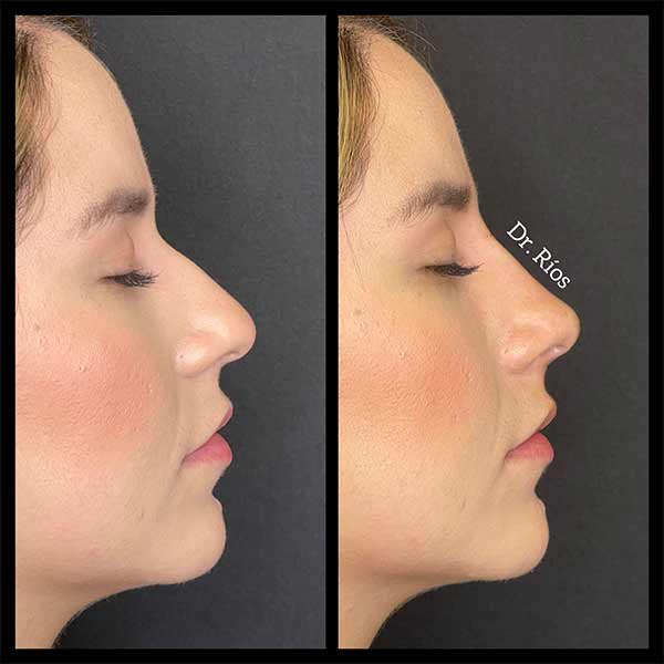 Non-Surgical Rhinoplasty Treatment in Verona, NJ