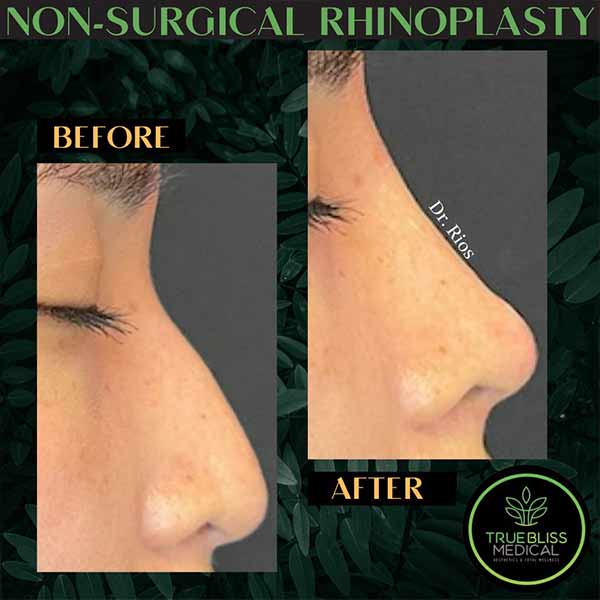 Non-Surgical Rhinoplasty Treatment in Verona, NJ