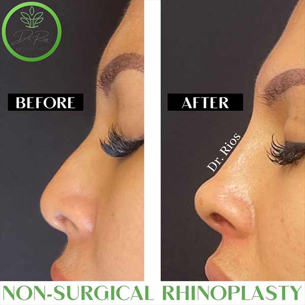 Non-Surgical Rhinoplasty Treatment in Verona, NJ