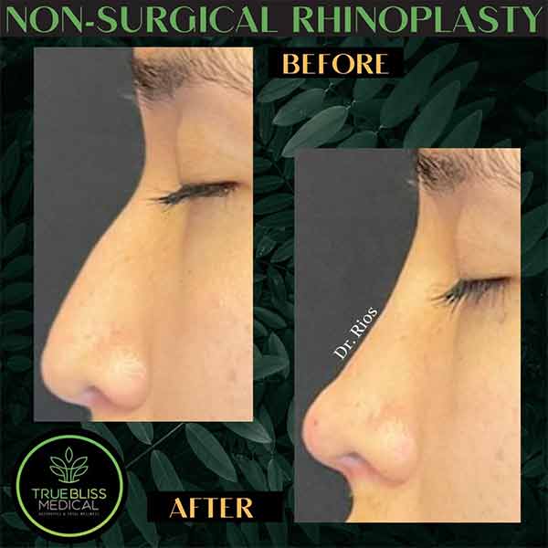 Non-Surgical Rhinoplasty Treatment in Verona, NJ