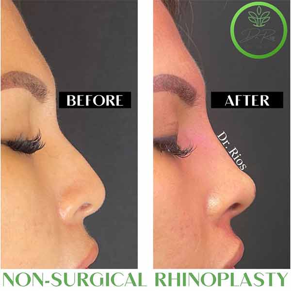 Non-Surgical Rhinoplasty Treatment in Verona, NJ