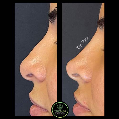 Non-Surgical Rhinoplasty Treatment in Verona, NJ