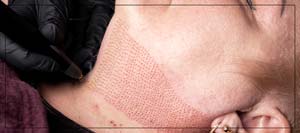 Plasma Fibroblast Treatment Specialist Near Me in Verona, NJ