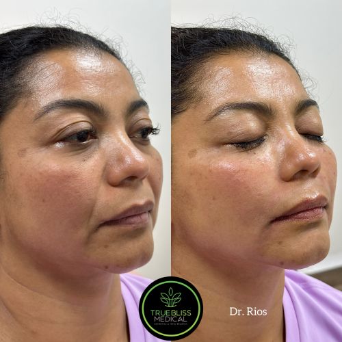 Facial Contouring Before & After in Verona, NJ