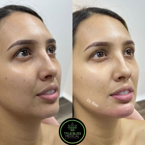Facial Contouring Before & After in Verona, NJ