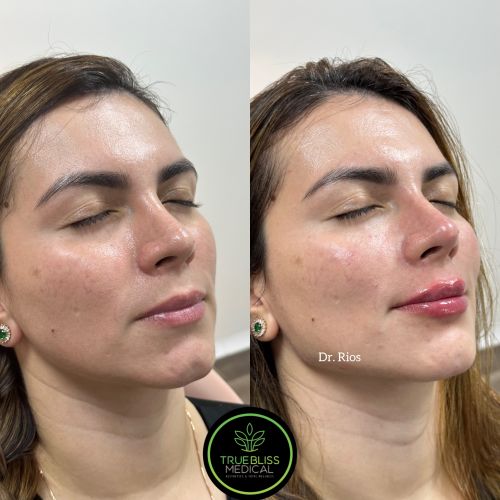 Facial Contouring Before & After in Verona, NJ