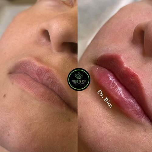 Lip Treatments Before & After in Verona, NJ