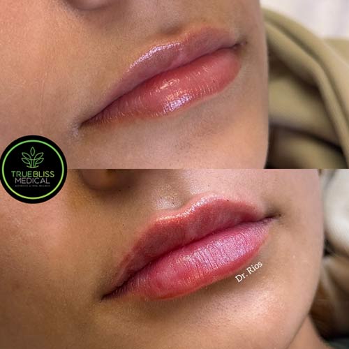 Lip Treatments Before & After in Verona, NJ