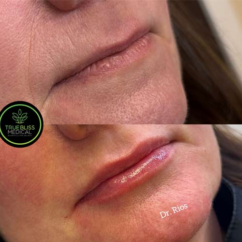 Lip Treatments Before & After in Verona, NJ