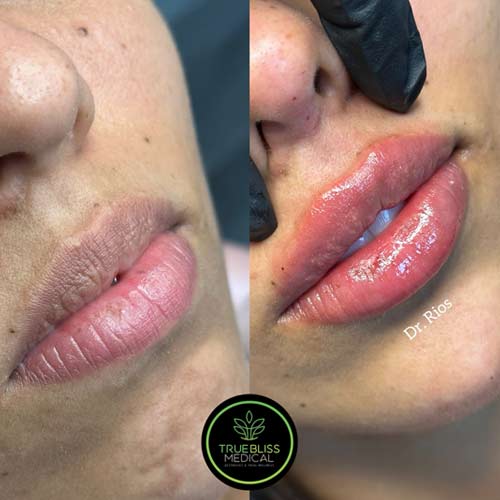 Lip Treatments Before & After in Verona, NJ
