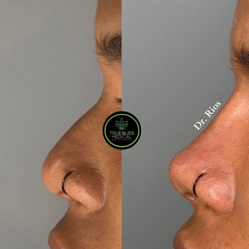 Non-Surgical Rhinoplasty Treatment in Verona, NJ
