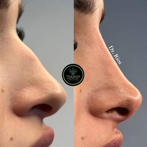 Non-Surgical Rhinoplasty Treatment in Verona, NJ