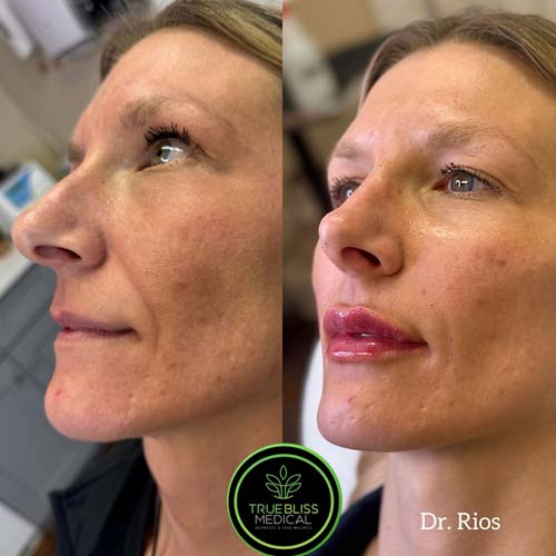 Facial Contouring Before & After in Verona, NJ