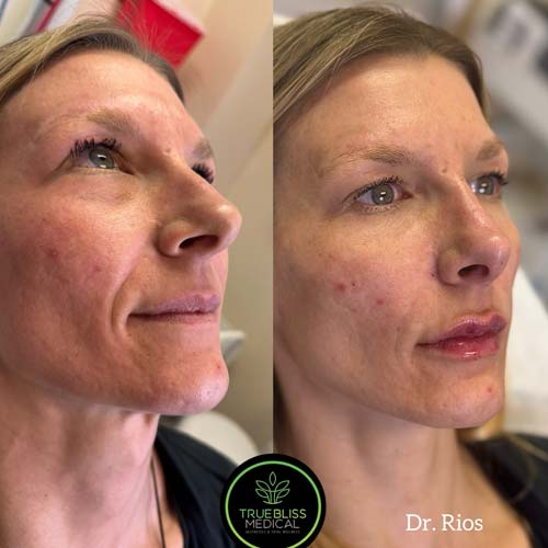 Facial Contouring Before & After in Verona, NJ