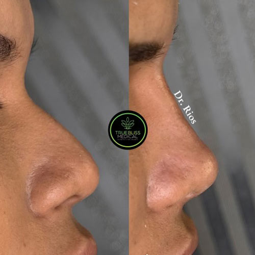 Non-Surgical Rhinoplasty Treatment in Verona, NJ