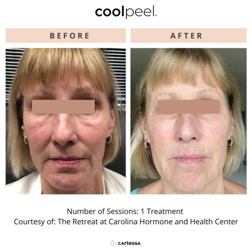 Tetra CO2 Cool Peel Laser Before & After in Verona, NJ