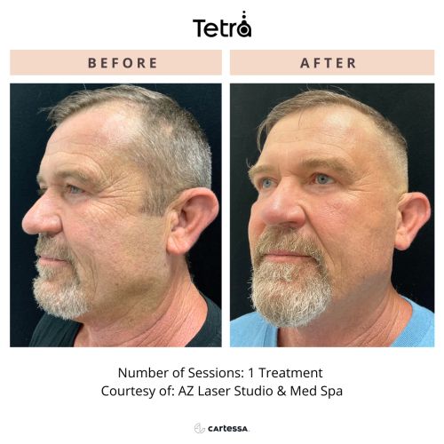 Tetra CO2 Cool Peel Laser Before & After in Verona, NJ