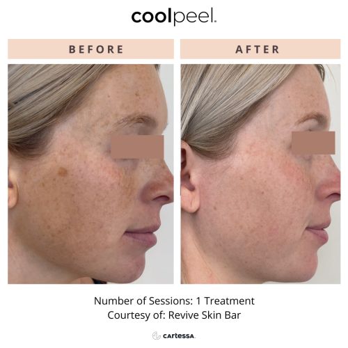 Tetra CO2 Cool Peel Laser Before & After in Verona, NJ