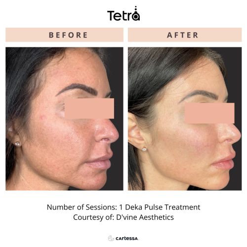 Tetra CO2 Cool Peel Laser Before & After in Verona, NJ