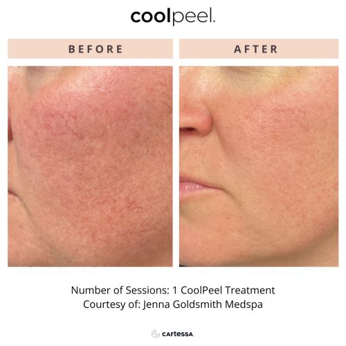 Tetra CO2 Cool Peel Laser Before & After in Verona, NJ