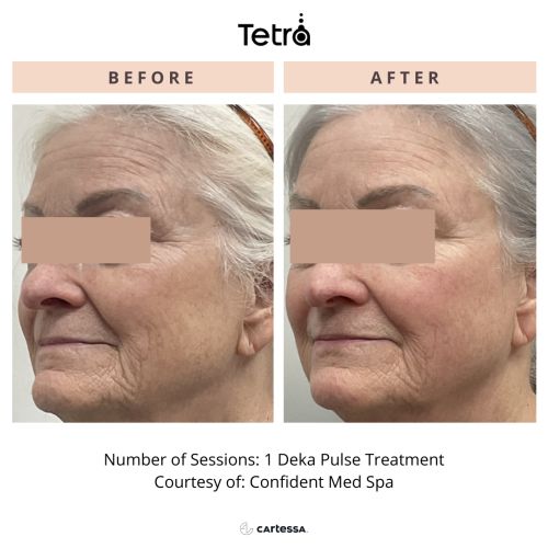 Tetra CO2 Cool Peel Laser Before & After in Verona, NJ