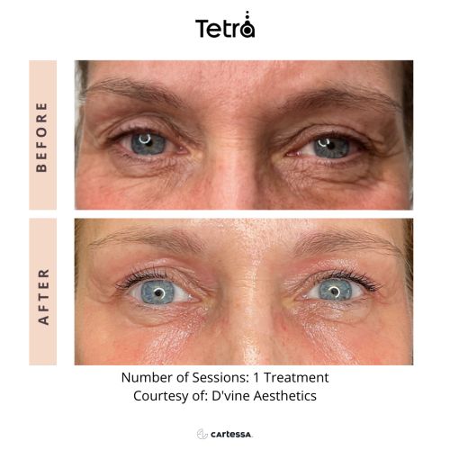Tetra CO2 Cool Peel Laser Before & After in Verona, NJ