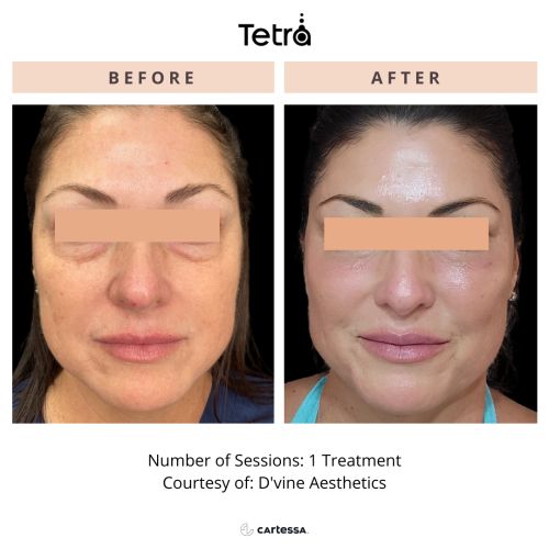 Tetra CO2 Cool Peel Laser Before & After in Verona, NJ