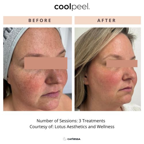Tetra CO2 Cool Peel Laser Before & After in Verona, NJ