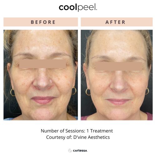 Tetra CO2 Cool Peel Laser Before & After in Verona, NJ