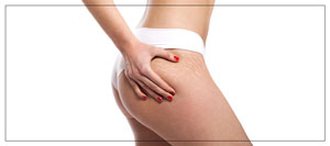 Stretch Marks Treatment with CO2 Cool Peel Laser Near Me in Verona, NJ