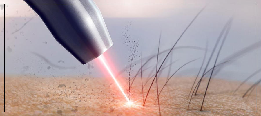 The Risks of Mismatched Laser Treatments: Understanding Skin and Laser Type Compatibility at True Bliss Medical in Verona, NJ