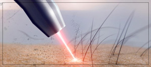 The Risks of Mismatched Laser Treatments: Understanding Skin and Laser Type Compatibility at True Bliss Medical in Verona, NJ