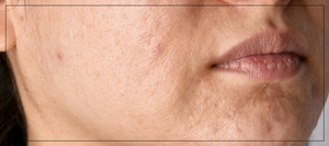 Treating Acne Scars with CO2 Cool Peel Laser at True Bliss Medical in Verona, NJ