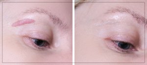 Botox for Hypertrophic Scars in Verona, NJ
