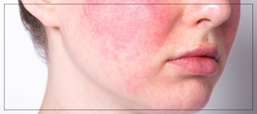Mesobotox for Rosacea: A Soothing Solution for Sensitive Skin by Dr. Rios