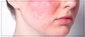 Mesobotox for Rosacea: A Soothing Solution for Sensitive Skin by Dr. Rios